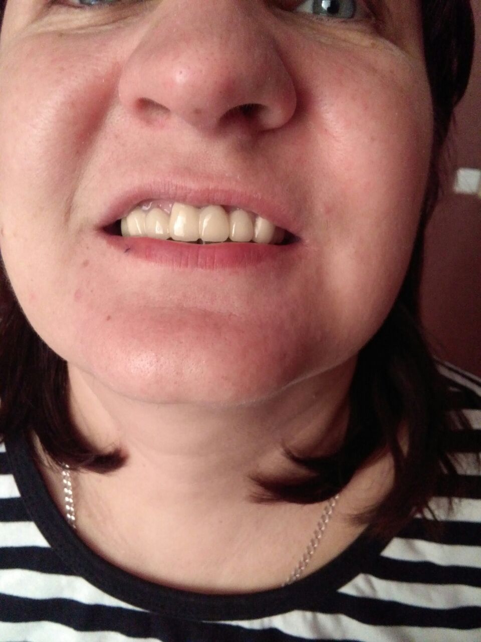 после лечения зубов в Китае